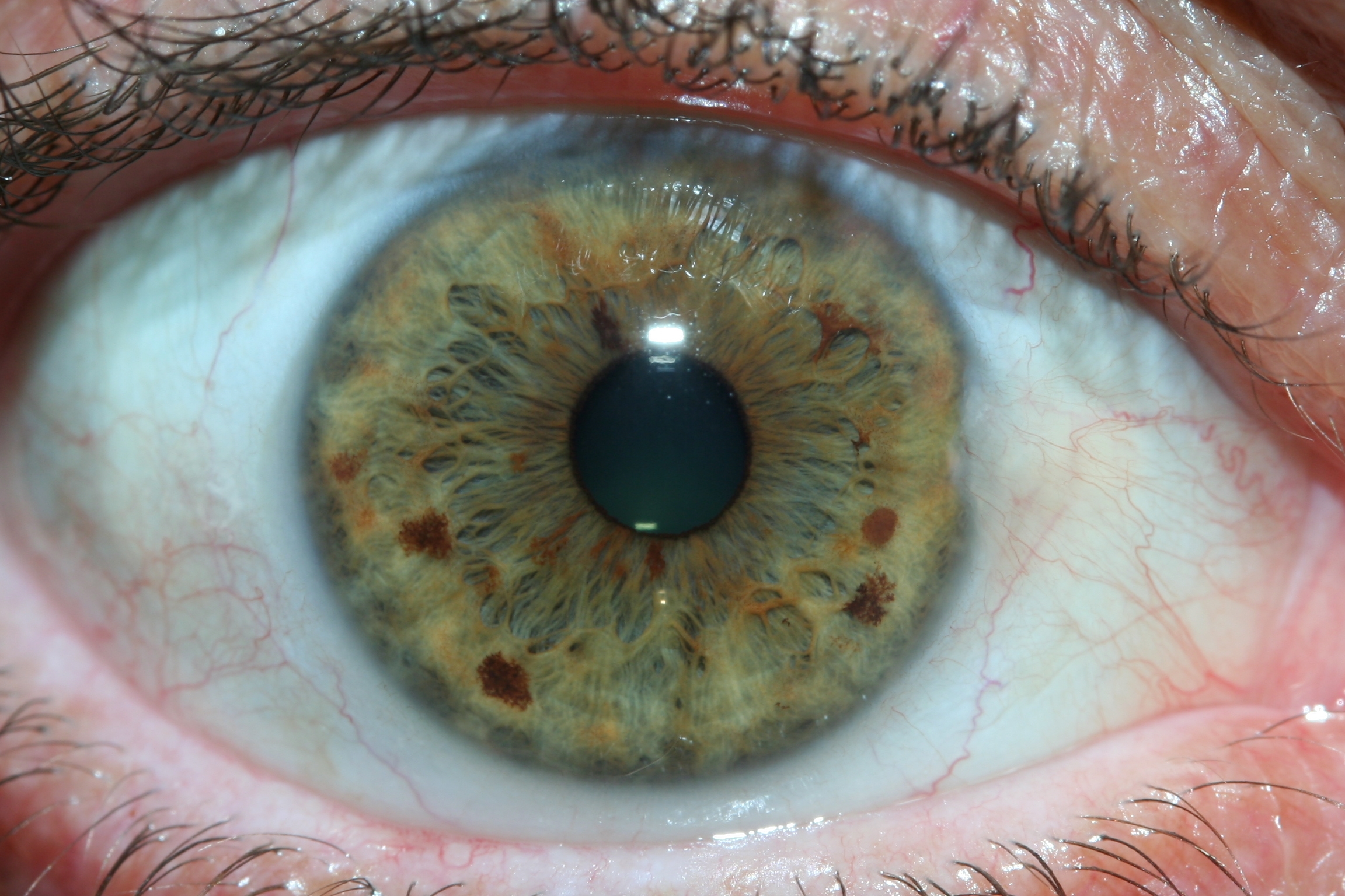 iridology constitutional
